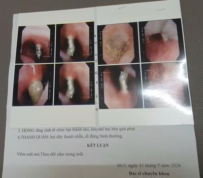 Niềng răng, vít chọc thẳng vào xoang mũi bệnh nhân, bệnh viện nói gì?