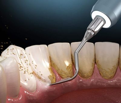 Vì sao nên lấy vôi răng thường xuyên?
