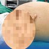Tưởng béo bụng, hóa ra mang khối u buồng trứng khổng lồ to 30cm