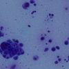 Bé 4 tuổi khỏe mạnh bất ngờ mắc cùng lúc 2 bệnh do virus VZV