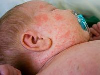 Cảnh báo những căn bệnh dễ mắc phải khi trời nồm ẩm và cách phòng tránh