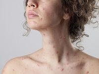 Cảnh báo những căn bệnh dễ mắc phải khi trời nồm ẩm và cách phòng tránh