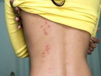 Cách phân biệt các vết đốt của côn trùng