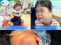 Cắt u nang bạch huyết khổng lồ, cứu bé gái 2 tuổi khỏi nguy kịch