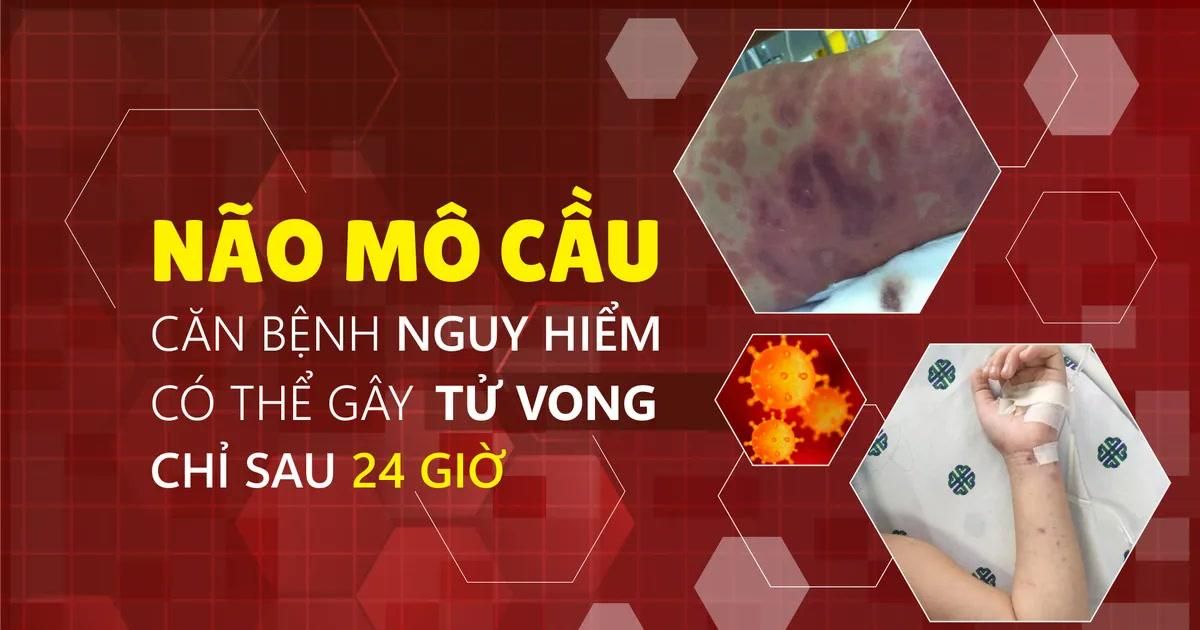 Não mô cầu – Căn bệnh nguy hiểm có thể gây tử vong chỉ sau 24 giờ