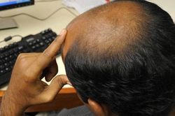 Đột phá trong chữa hói đầu