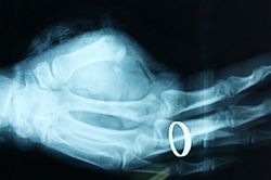 Nối ngón tay thành công cho một bệnh nhân ở Nghệ An