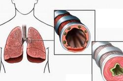 Tiết xuân nên cẩn trọng bệnh hen ở trẻ em