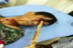 Hy hữu cứu sống nam thanh niên bị cọc đâm xuyên mắt phải