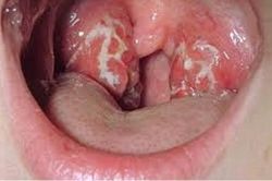Bệnh bạch hầu khiến 3 người tử vong nguy hiểm thế nào?