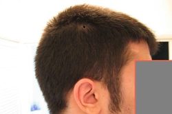Nhìn nốt ruồi trên đầu, biết ngay giàu nghèo lành dữ