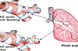 Mẹo phân biệt hen phế quản và tắc nghẽn phổi mãn tính