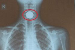 Hà Tĩnh: Bé gái nuốt đồng xu 2 cm vào cổ lúc chơi đùa