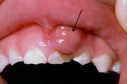 Dấu hiệu ung thư khoang miệng dễ bị bỏ qua