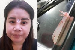 Ham hố nâng mũi giá rẻ, cô gái nhận cái kết không thể đắng hơn