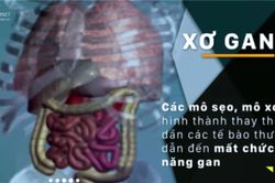 'Sát thủ giấu mặt' gây xơ gan