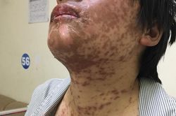 Mề đay nổi từng dề do tùy tiện uống thuốc cảm
