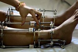 Kéo dài chân tăng chiều cao: Cắt xương, đeo khung hàng tháng trời