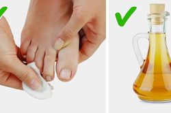 Trị móng chân đâm vào thịt hiệu quả bằng mẹo hết sức đơn giản