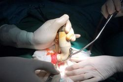 Cấp cứu nam thanh niên bị chiếc vòi xịt nước bồn cầu chui tọt vào hậu môn