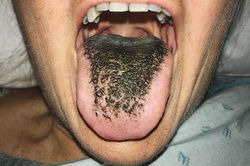Mỹ: Kỳ lạ người phụ nữ mọc lông đen xì ở lưỡi