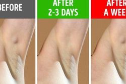 Đừng cố tình bỏ qua 6 biểu hiện ở nách vì nó có thể chỉ ra bệnh tiềm ẩn, không ngoại trừ ung thư