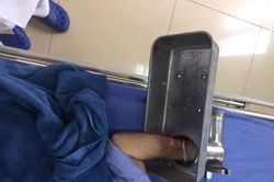 Người phụ nữ cấp cứu với bàn tay nằm trong máy xay thịt