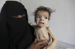 Tình cảnh không thể tồi tệ hơn của những 'bộ xương di động' ở Yemen