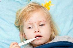 Bé gái 7 tuổi biến chứng viêm phổi nặng do bệnh sởi