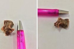 Gắp cục xương heo trong thực quản một phụ nữ