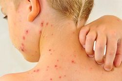Cách phòng sởi cực kỳ hiệu quả cho trẻ, cha mẹ nên biết