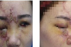 Cô gái 27 tuổi mù một mắt vì tiêm filler để nâng mũi