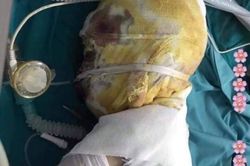 Xót xa cậu bé người Dao 9 tuổi bị bỏng ăn sâu hở xương sọ, gia đình quá nghèo