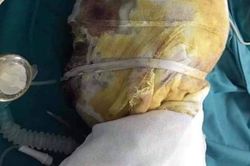 Xót xa cậu bé người Dao 9 tuổi bị bỏng ăn sâu hở xương sọ, gia đình quá nghèo