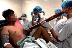 Đâm vào dải phân cách, một người bị ống sắt dài 2m đâm thấu ngực