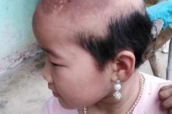 Số phận đáng thương của bé gái 3 lần phẫu thuật u não ác tính