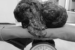 Phẫu thuật bóc khối u mạc treo ruột khổng lồ 3,5kg từ bụng người đàn ông