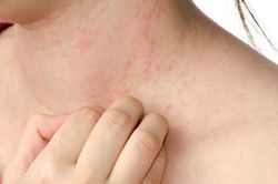 Tự tắm nước lá, cúng bái chữa bệnh, một phụ nữ bị lột da toàn thân