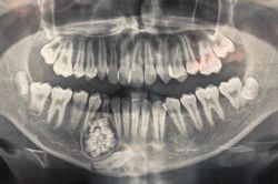 Phẫu thuật lấy ra 100 cái răng trong ca u răng