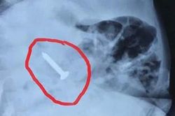 Bé 20 tháng tuổi nuốt chiếc đinh vít sắc nhọn dài đến 3,5 cm