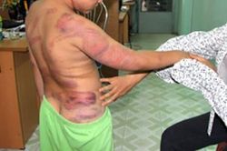 Bé trai 6 tuổi nghi bị mẹ ruột bạo hành dã man