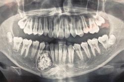 Bệnh viện Đa khoa tỉnh: Mổ u răng lấy ra gần 100 cái răng