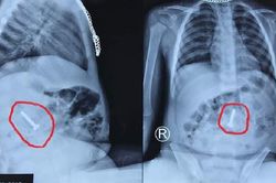 Đinh vít 3,5 cm trong bụng bé 20 tháng tuổi