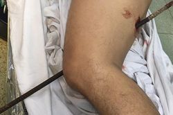 Ngã từ độ cao 5 mét xuống đất, nam thanh niên bị thanh sắt đâm xuyên đùi