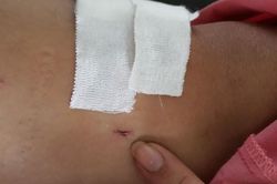 Khoan nhầm cẳng chân khi bệnh nhân gãy đốt sống ngực