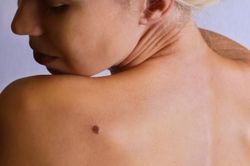 Kiểm tra nốt ruồi 3 tháng một lần để chặn đứng ung thư da