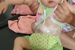 Đau xót cảnh bé gái 18 tháng tuổi, nặng 6kg, 3 lần phẫu thuật vẫn phải treo ruột ngoài thành bụng