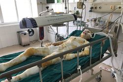 Sụt lò luyện gang, 5 công nhân bị bỏng