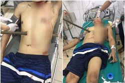 Người đàn ông may mắn thoát chết khi bị cọc gỗ đâm xuyên người