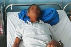 Hy hữu bã xơ mít dài 40cm nằm trong dạ dày bệnh nhân 60 tuổi